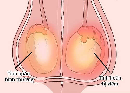 Viêm tinh hoàn